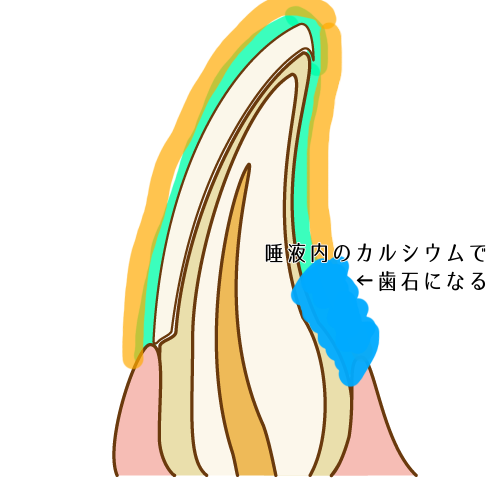 歯石の付いた歯の表面
